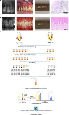 Identification of nine signature proteins involved in periodontitis by integrated analysis of TMT proteomics and transcriptomics